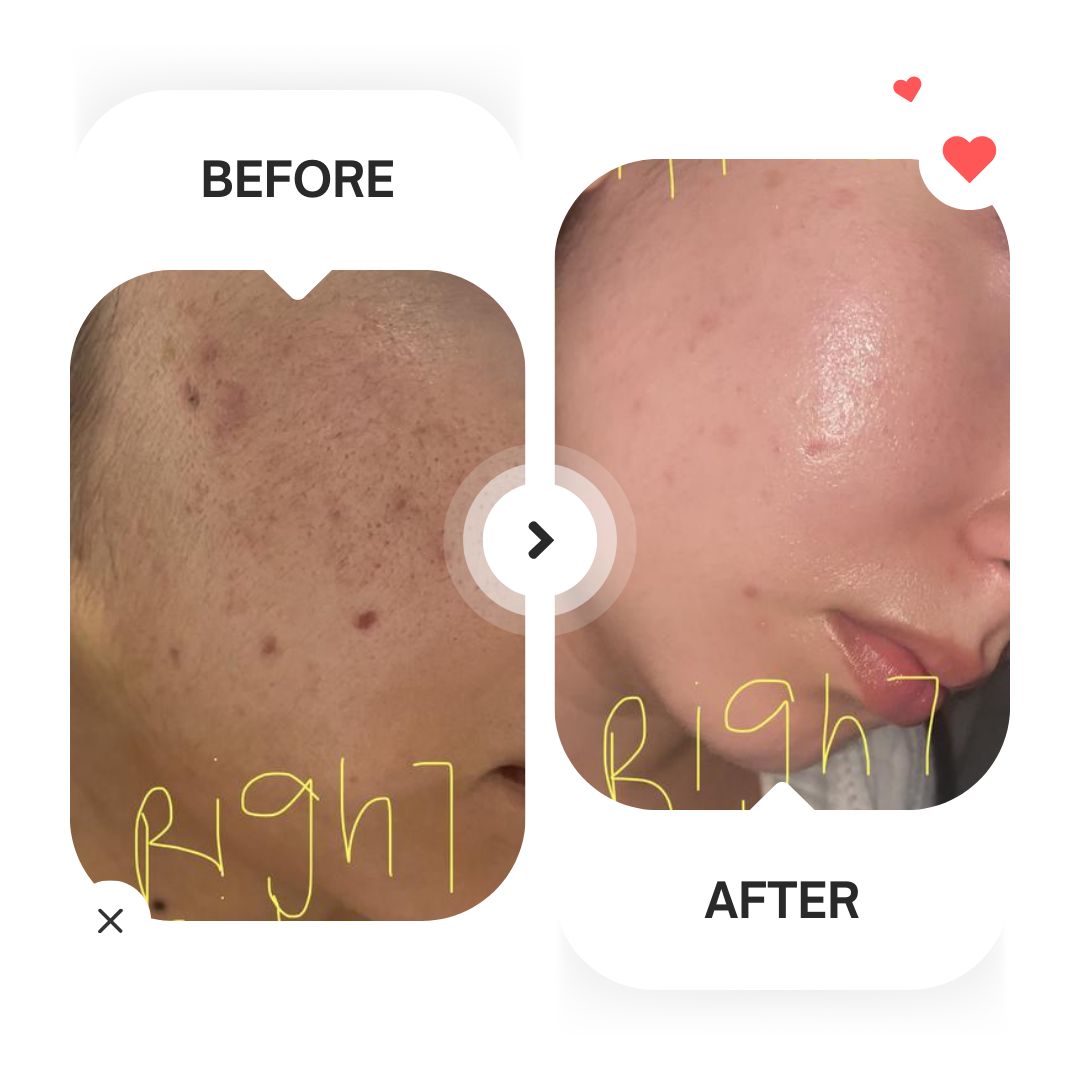 Alpha Arbutin 2% + HA (Dark Spots Remover)